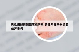 男性阴部两侧银屑病严重 男性阴部两侧银屑病严重吗