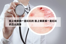 脸上银屑病一直红红的 脸上银屑病一直红红的怎么回事