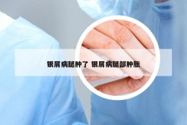 银屑病腿肿了 银屑病腿部肿胀