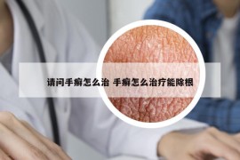 请问手癣怎么治 手癣怎么治疗能除根