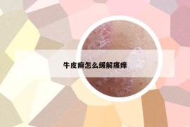 牛皮癣怎么缓解瘙痒