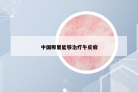 中国哪里能够治疗牛皮癣