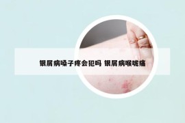 银屑病嗓子疼会犯吗 银屑病喉咙痛