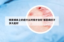 银屑病身上的疤什么时候才会好 银屑病印子多久能好