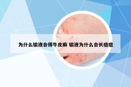 为什么输液会得牛皮癣 输液为什么会长痘痘