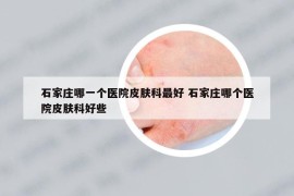 石家庄哪一个医院皮肤科最好 石家庄哪个医院皮肤科好些