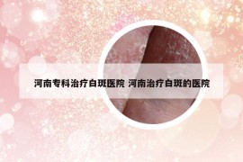 河南专科治疗白斑医院 河南治疗白斑的医院