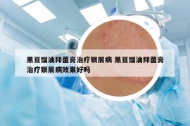 黑豆馏油抑菌膏治疗银屑病 黑豆馏油抑菌膏治疗银屑病效果好吗