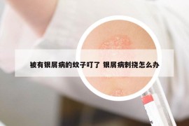 被有银屑病的蚊子叮了 银屑病刺挠怎么办