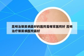 昆明治银屑病最好的医院是哪家医院好 昆明治疗银屑病医院最好