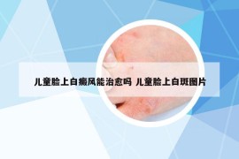 儿童脸上白癜风能治愈吗 儿童脸上白斑图片