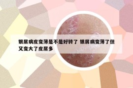 银屑病皮变薄是不是好转了 银屑病变薄了但又变大了皮屑多