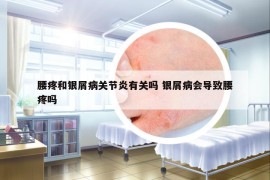 腰疼和银屑病关节炎有关吗 银屑病会导致腰疼吗