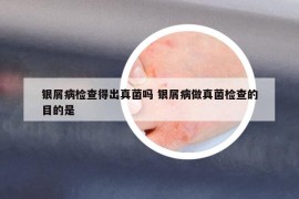 银屑病检查得出真菌吗 银屑病做真菌检查的目的是