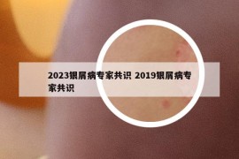 2023银屑病专家共识 2019银屑病专家共识