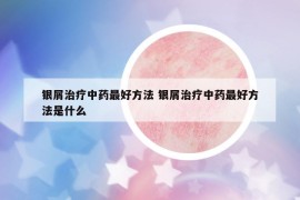 银屑治疗中药最好方法 银屑治疗中药最好方法是什么