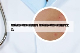 银癣病和银屑病相同 银癣病和银屑病相同之处