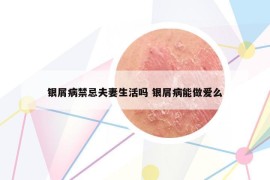 银屑病禁忌夫妻生活吗 银屑病能做爱么