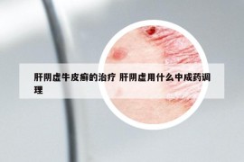 肝阴虚牛皮癣的治疗 肝阴虚用什么中成药调理