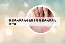 银屑病关节炎为啥查尿常现 银屑病关节炎化验什么