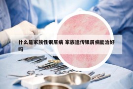 什么是家族性银屑病 家族遗传银屑病能治好吗