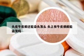 头皮牛皮癣还能染头发么 头上有牛皮病癣能染发吗