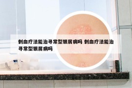 刺血疗法能治寻常型银屑病吗 刺血疗法能治寻常型银屑病吗