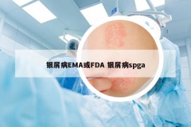 银屑病EMA或FDA 银屑病spga