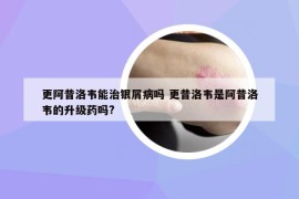 更阿昔洛韦能治银屑病吗 更昔洛韦是阿昔洛韦的升级药吗?