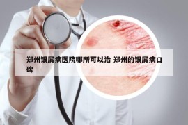 郑州银屑病医院哪所可以治 郑州的银屑病口碑