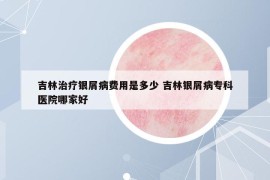 吉林治疗银屑病费用是多少 吉林银屑病专科医院哪家好