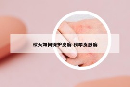 秋天如何保护皮癣 秋季皮肤癣