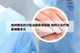 榆树嫩皮的汁能治银屑病视频 榆树汁治疗银屑病要多久