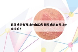 银屑病患者可以吃南瓜吗 银屑病患者可以吃南瓜吗?