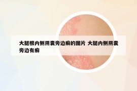 大腿根内侧阴囊旁边癣的图片 大腿内侧阴囊旁边有癣