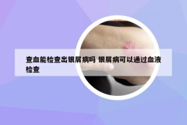 查血能检查出银屑病吗 银屑病可以通过血液检查