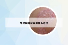 牛皮癣用可以用什么泡泡