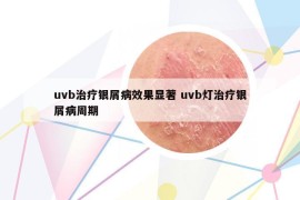 uvb治疗银屑病效果显著 uvb灯治疗银屑病周期