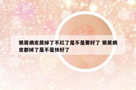 银屑病皮屑掉了不红了是不是要好了 银屑病皮都掉了是不是快好了