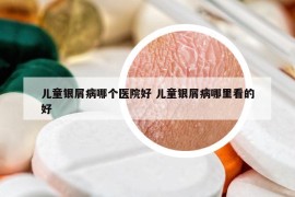 儿童银屑病哪个医院好 儿童银屑病哪里看的好