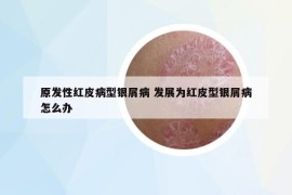 原发性红皮病型银屑病 发展为红皮型银屑病怎么办