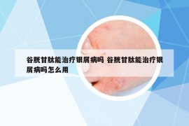 谷胱甘肽能治疗银屑病吗 谷胱甘肽能治疗银屑病吗怎么用