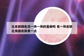 比皮肤颜色深一块一块的是癣吗 有一块皮肤比周围皮肤黑一点