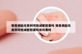 银屑病能吃奥利司他减肥胶囊吗 银屑病能吃奥利司他减肥胶囊吗有效果吗