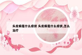 头皮癣是什么症状 头皮癣是什么症状,怎么治疗