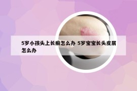 5岁小孩头上长癣怎么办 5岁宝宝长头皮屑怎么办