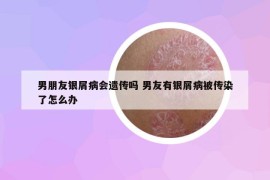 男朋友银屑病会遗传吗 男友有银屑病被传染了怎么办