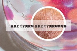 屁股上长了类似癣 屁股上长了类似癣的疙瘩