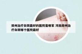 郑州治疗白斑最好的医院是哪家 河南郑州治疗白斑哪个医院最好