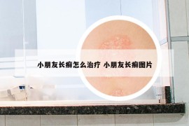 小朋友长癣怎么治疗 小朋友长癣图片